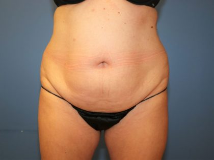 Tummy Tuck Before & After Patient #6439