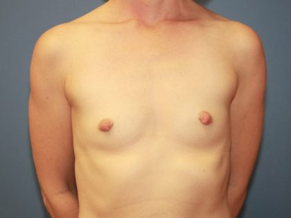 Breast Augmentation Before & After Patient #7361