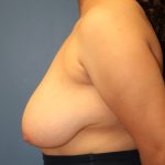 Breast Reduction Before & After Patient #6969
