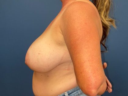 Breast Reduction Before & After Patient #6914