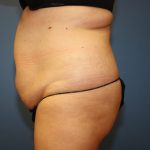 Tummy Tuck Before & After Patient #6439