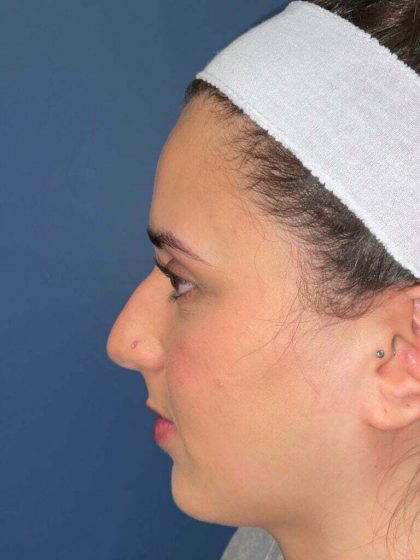 Rhinoplasty Before & After Patient #6718