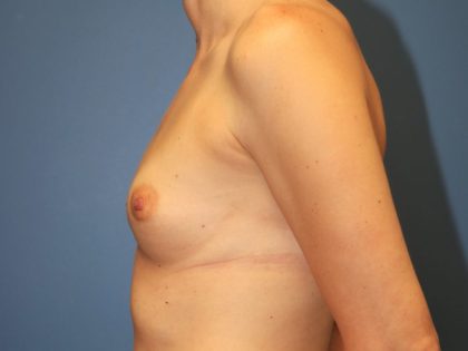 Breast Augmentation Before & After Patient #7359