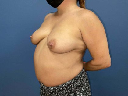 Breast Augmentation + Lift Before & After Patient #7621