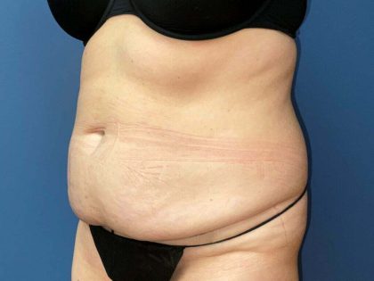 Tummy Tuck Before & After Patient #6437