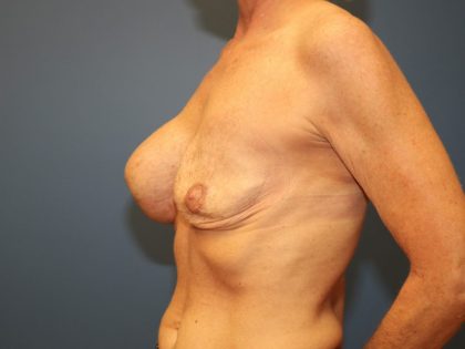 Breast Revision Before & After Patient #7492