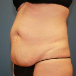 Tummy Tuck Before & After Patient #6440