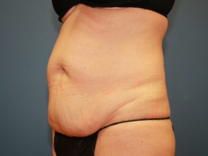 Tummy Tuck Before & After Patient #6440