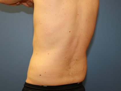 Liposuction Before & After Patient #5875