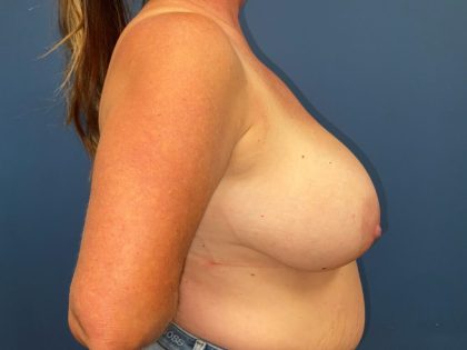 Breast Reduction Before & After Patient #6914