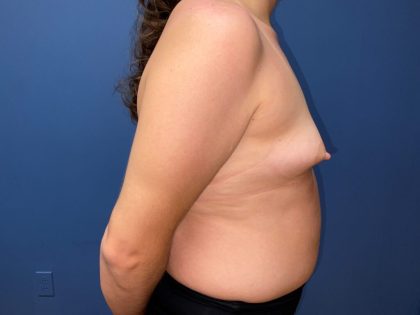 Tuberous Breast Correction Before & After Patient #7650