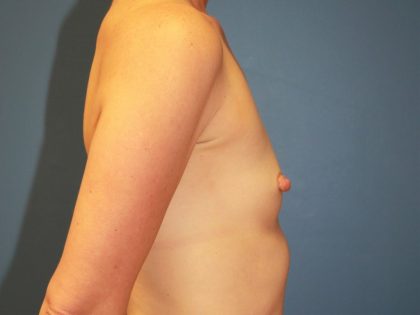 Breast Augmentation Before & After Patient #7361