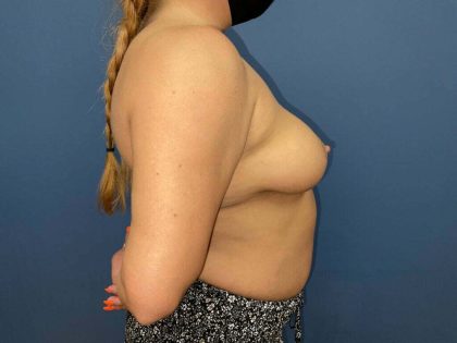 Breast Augmentation + Lift Before & After Patient #7621