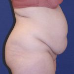 Tummy Tuck Before & After Patient #6438