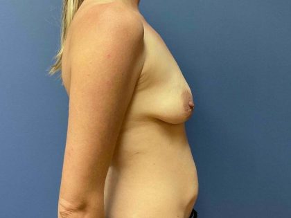 Breast Augmentation + Lift Before & After Patient #7617