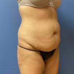 Tummy Tuck Before & After Patient #6598