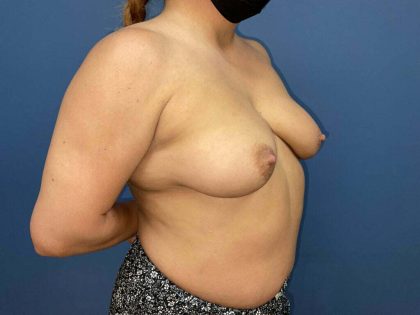 Breast Augmentation Before & After Patient #7403