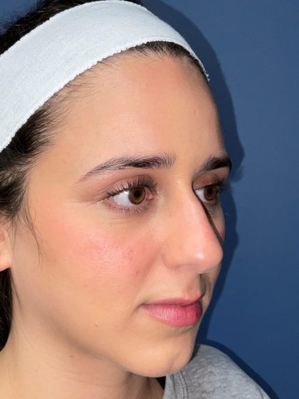 Rhinoplasty Before & After Patient #6718
