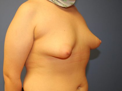 Tuberous Breast Correction Before & After Patient #7629