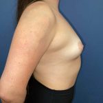 Breast Augmentation Before & After Patient #7401