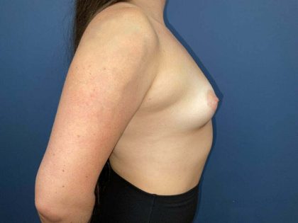 Breast Augmentation Before & After Patient #7401