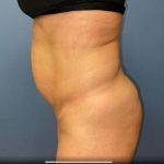 Tummy Tuck Before & After Patient #6527