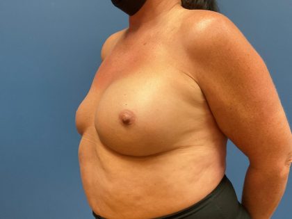 Breast Revision Before & After Patient #7470