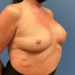 Breast Revision Before & After Patient #7470