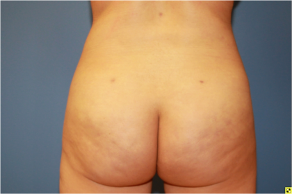 Brazilian Butt Lift Before & After Patient #5833
