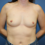 Breast Augmentation Before & After Patient #7395