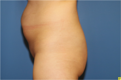 Brazilian Butt Lift Before & After Patient #5833