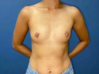 Breast Augmentation Before & After Patient #6927