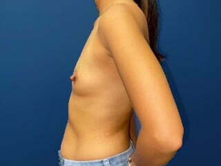 Breast Augmentation Before & After Patient #6929