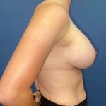 Breast Augmentation Before & After Patient #6931