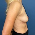 Breast Augmentation Before & After Patient #6931