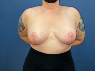 Breast Revision Before & After Patient #7148