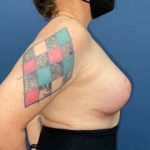 Breast Revision Before & After Patient #7148