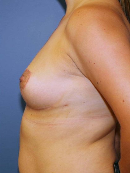 Breast Lift Before & After Patient #7106