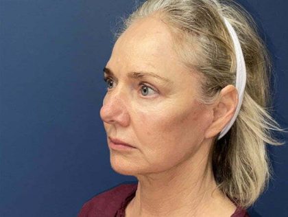 Facelift Before & After Patient #6650