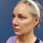 Facelift Before & After Patient #6650
