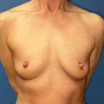 Breast Augmentation Before & After Patient #6928
