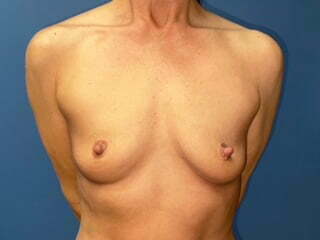Breast Augmentation Before & After Patient #6926