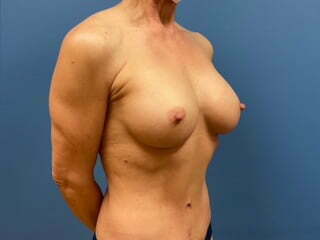 Breast Augmentation Before & After Patient #6928