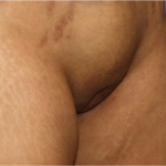 Liposuction Before & After Patient #5878