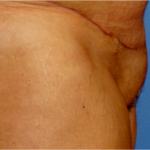 Liposuction Before & After Patient #5877