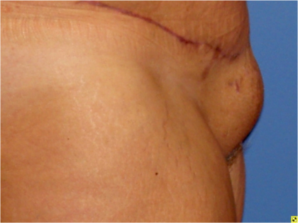 Liposuction Before & After Patient #5877