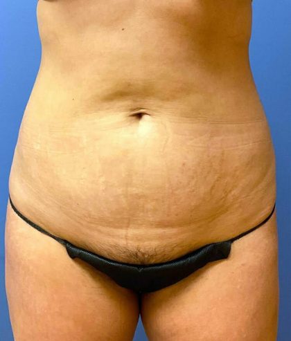 Tummy Tuck Before & After Patient #6431