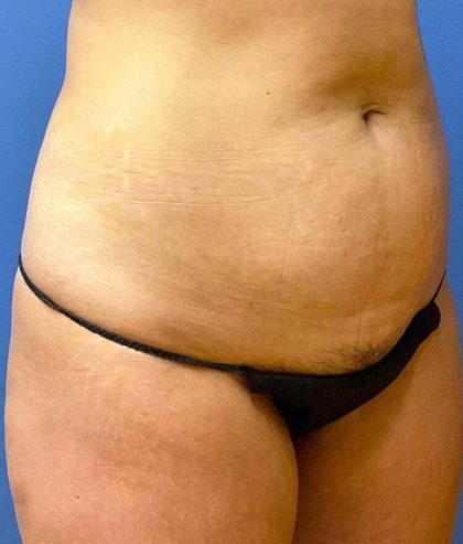 Tummy Tuck Before & After Patient #6431