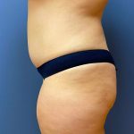 Tummy Tuck Before & After Patient #6432