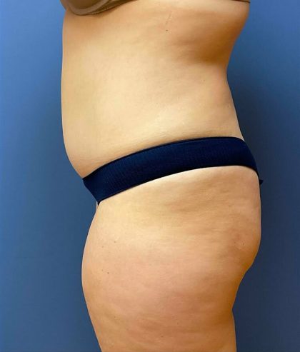 Tummy Tuck Before & After Patient #6432